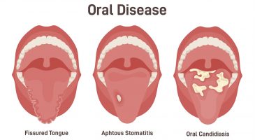 Conseil sexe : Comment se transmet une candidose buccale ?